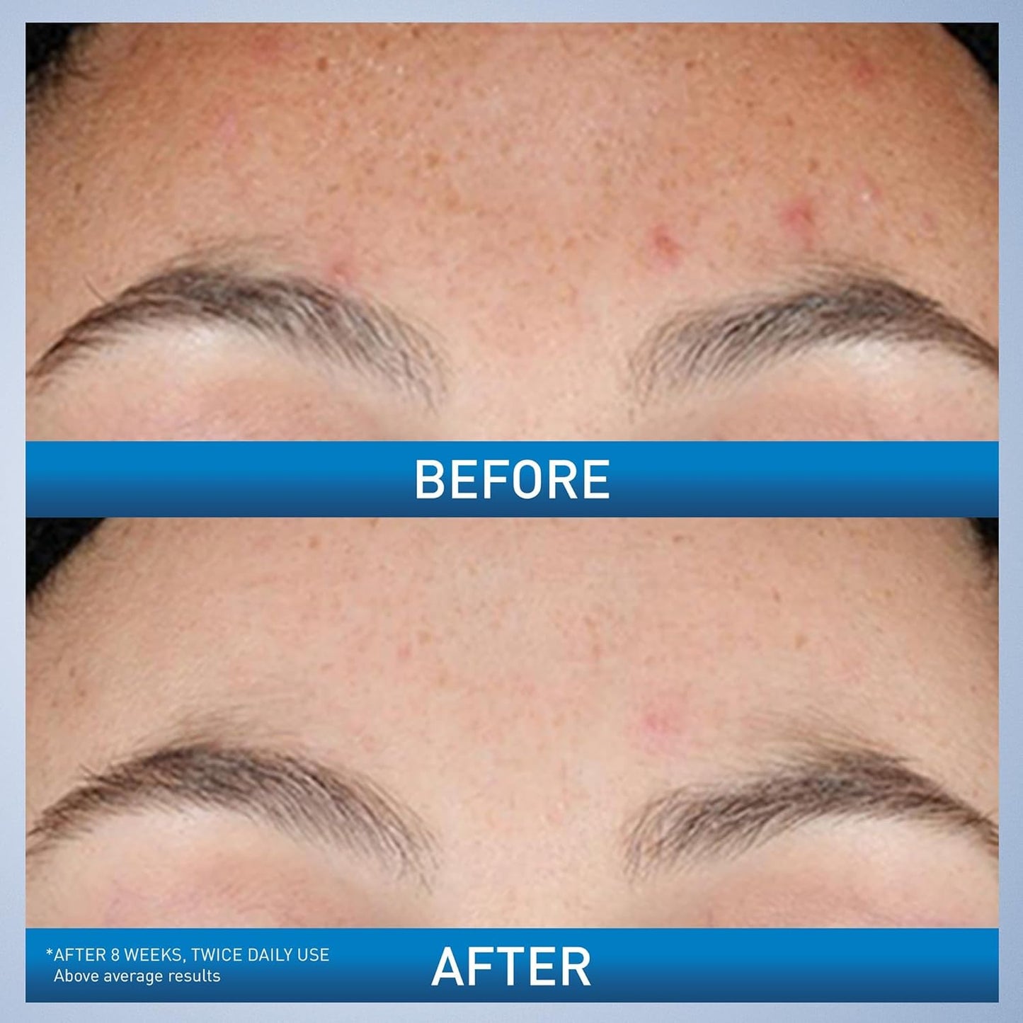 CeraVe Resurfacing Retinol Serum – 30 ml | For Post-Acne Marks & Uneven Skin Texture