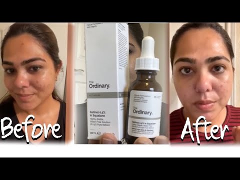 The Ordinary Retinol 0.5% in Squalane, Intermediate Retinol Serum for the Face That Is Anti-Aging and Skin Smoothing, 1 Fl Oz