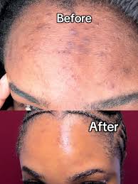 ANUA Niacinamide 10 + TXA 4 Serum, Hyaluronic Acid, Tranexamic acid, Vitamin B12