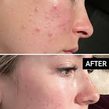 The Ordinary Granactive Retinoid 2% in Squalane 30 ml