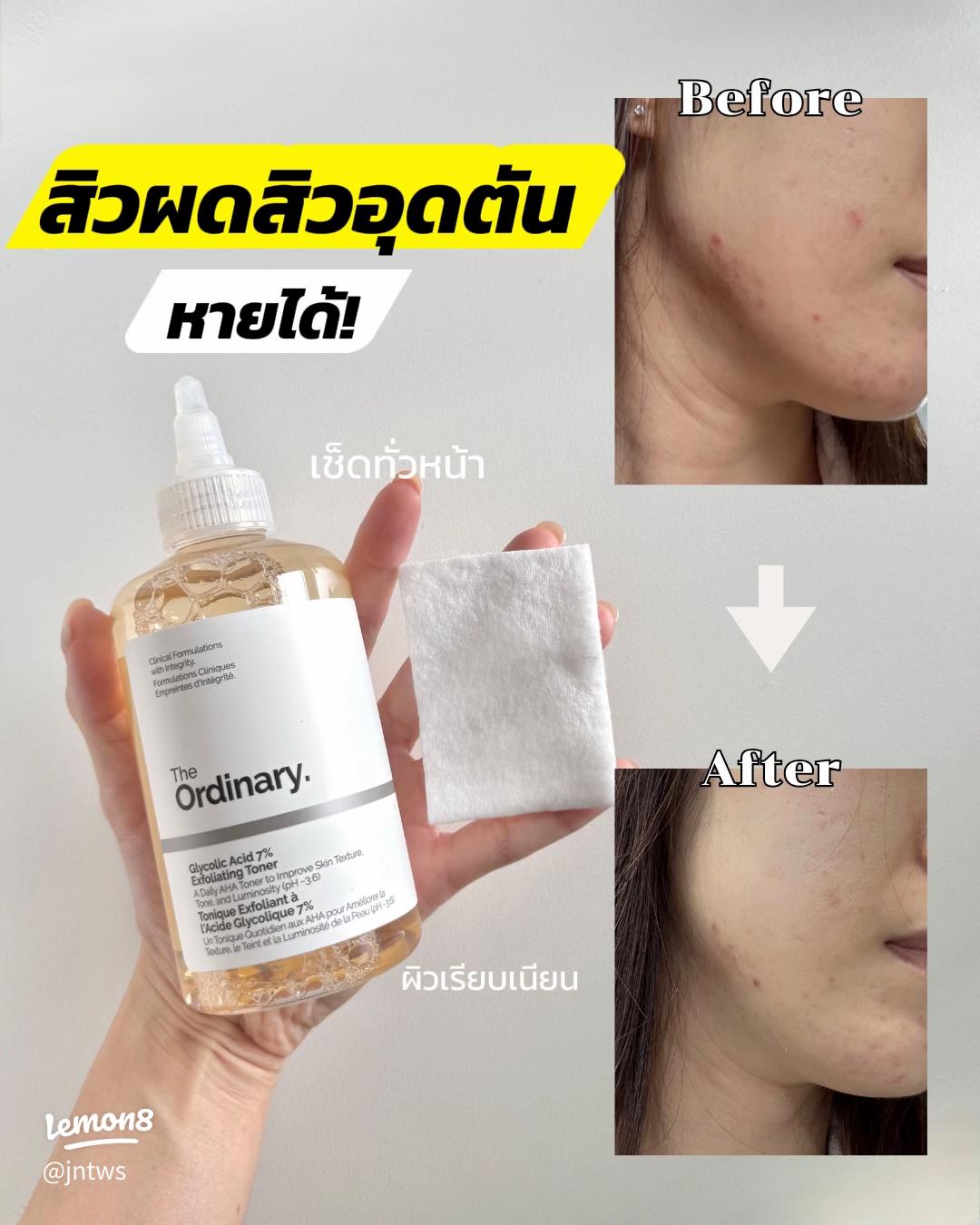 The Ordinary Glycolic Acid 7% Exfoliating Toner, Brightening and Smoothing Daily Toner for More Even-Looking Skin Tone, 8.1 Fl Oz